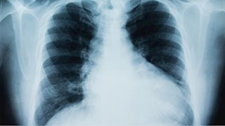 Mobile lung cancer screening program to assist in early detection