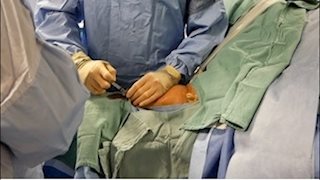 New minimally-invasive procedure prepares patients for kidney dialysis