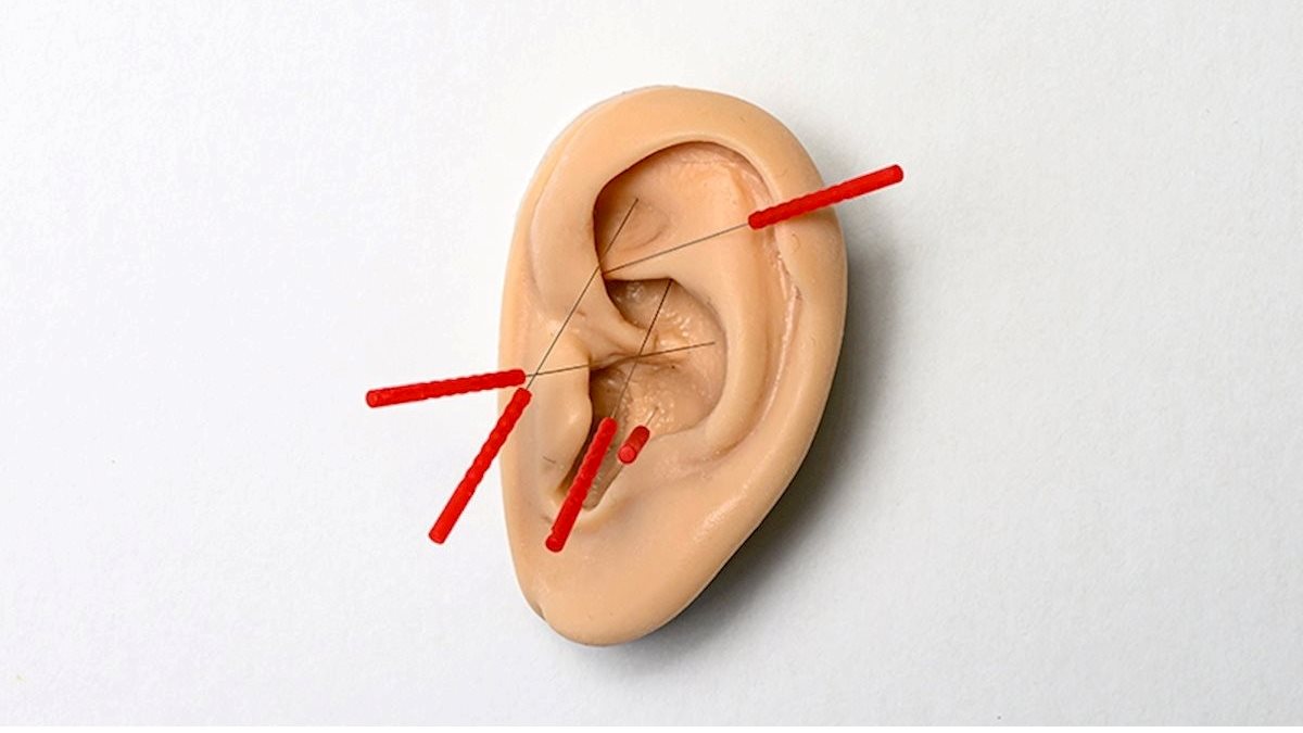 Registration for the April 18, 2026, WVU Auricular Acupuncture Badge is now open for faculty, residents, and medical students