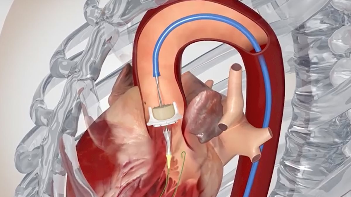 Transcatheter Aortic Valve Replacement Tavr School Of Medicine