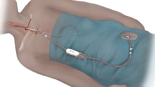 WVU Heart and Vascular Institute offering new procedure for carotid artery disease