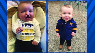 WVU Medicine Children’s Cleft Lip and Palate Team delivers smiles