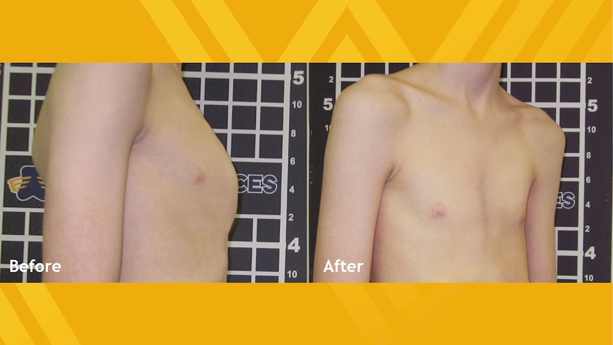 Appearance of chest wall before operation.