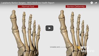 WVU Medicine Health Report - Lapiplasty bunion surgery