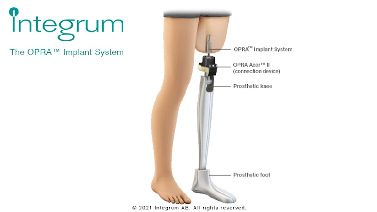 WVU Medicine introduces osseointegrated prosthesis technology