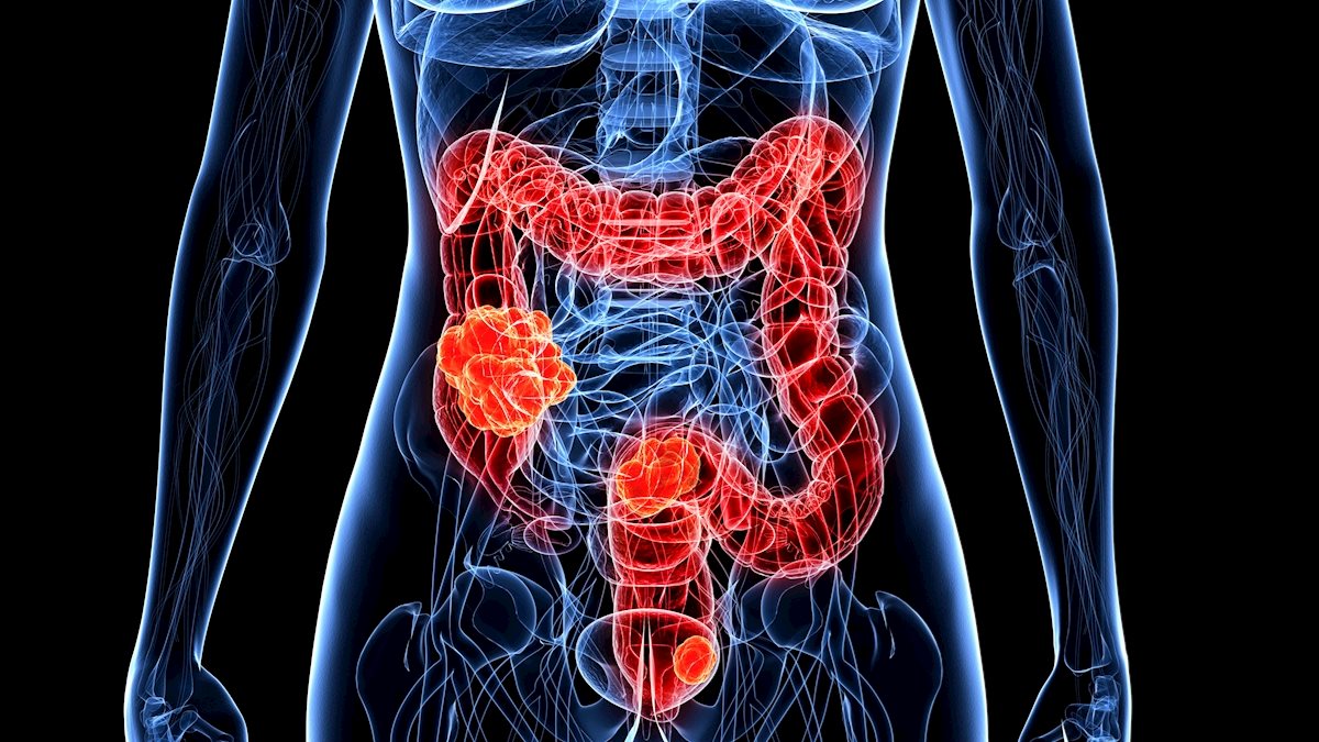 WVU Medicine offers colon cancer screening kits